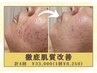 【肌質徹底改善】ハーブピーリング 3回券+1回サービス付き☆¥33,000