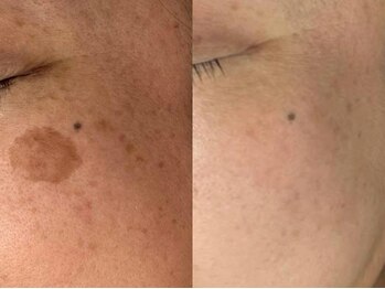 シミケア専門店 SAKURA 平塚店/【平塚シミケア・たるみケア】