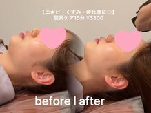 ソワン ド ブランシュ ライフ八戸ノ里店(Soin de Blanche)/酸素ケアで輪郭キープ