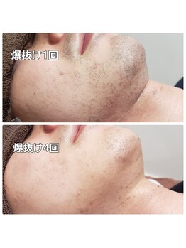 エステティック らぽーる(Rapport)/ヒゲ爆抜けモード