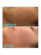 ザ フェース 京都御池店(THE FAITH)/お客様のお肌変化