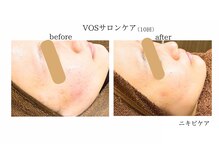 アボット(ABBOTT)/VOSサロンケア10回　20代