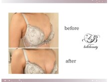 ベルビューティー(belle beauty)/バストアップ◇症例◇