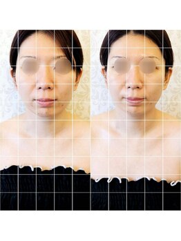 ディーバ 北浜(Diva)/毛穴洗浄付き！韓国小顔コルギ