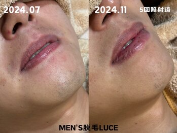 ルーチェ/【ヒゲ脱毛】清潔感溢れるお肌に