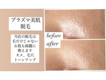 リアンジェ(Lianje)の雰囲気（毛やお肌、毛穴ケア、プラズマ脱毛がおすすめです(^^)）