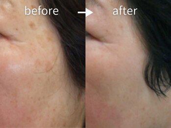 アルカンシエル(arcenciel)/シミ・シワ改善コース