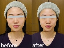 メナードフェイシャルサロン 西五反田/小顔/顎出し/引き上げ