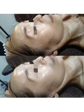 ボーソリューション(Beau-Solution)/【40代　しみ・くすみケア　】