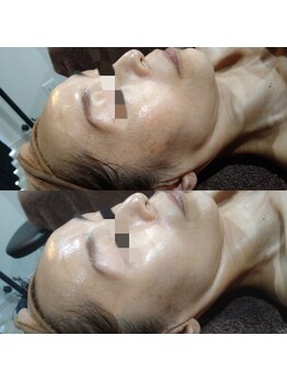 ボーソリューション(Beau-Solution)/【40代　しみ・くすみケア　】