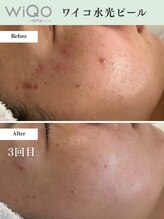 ギーク ラボ(GEEK LABO)/ワイコ水光ピール5回