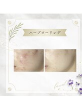 アディッシモ(addissimo)/気になる跡や赤みにも☆