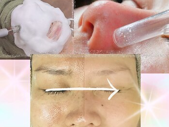 ナイア(naia)の写真/【黒ずみ毛穴が気になる方へ】吸引器具で汚れをすっきり除去！電気の力で毛穴を引き締め、黒ずみを予防♪