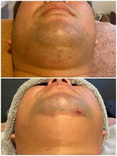 サボ 福岡(SAVO)/【お髭脱毛20回】