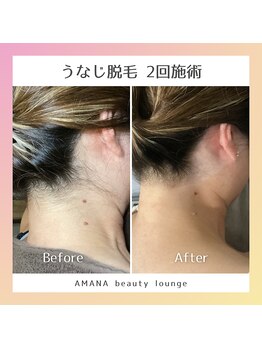アマナ(AMANA)/【うなじ脱毛】後ろ姿も美人に!