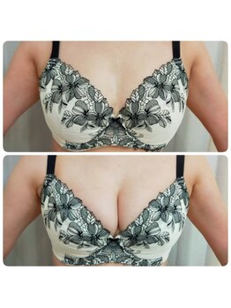 美人バスト リグラス(ReGrous)/バストアップbefore,after