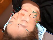 代々木美容鍼灸サロン さくら/美容鍼