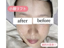 チュルリ 新町店(Chururi)/小顔/リフトアップ