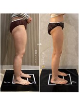 OBS新潟整骨院/新潟初の脂肪冷却PRO