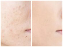 ルクシア(RUXCIA)/ビフォーアフターピーリング14回