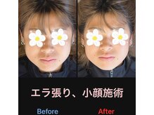美容矯正サロン レレポノ(LELEPONO)/エラ張り施術