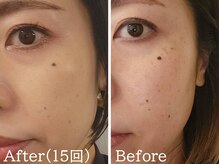 ルナステラ 金沢店/セルマン艶肌ピーリング