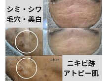 ネイルサロン併設/【lobe】シミ・シワ・ニキビケア・毛穴・美白