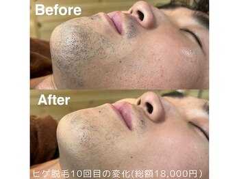 エゾボリック(EZOBOLIC)