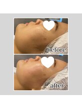 アデル 久留米(ADEL)/《全顔》フェイシャルワックス