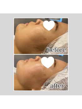 アデル 久留米(ADEL)/《全顔》フェイシャルワックス