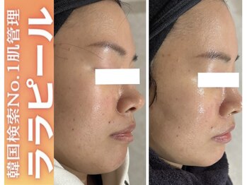 ブレア(Blair)/ララピール