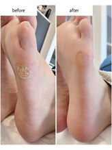 ケアプラス(care plus)/足裏角質ケア