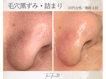 スリースリー(THREE THREE)/毛穴黒ずみ・詰まりケア