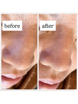 リエイト(Re:eight)/ハイドラ+ハーブピーリング