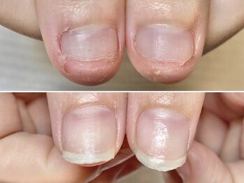 グラシュータン(gracieux temps)/【深爪矯正13000円】