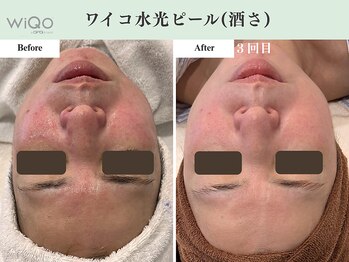 ギーク ラボ(GEEK LABO)/ワイコ水光ピール