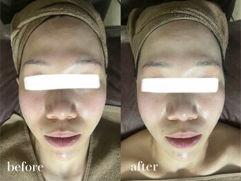 パルフェ(Parfait)/ハーブピーリング 