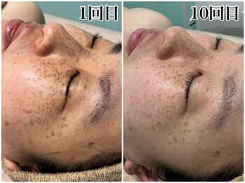 リセットラボ 本店(Reset Lab)/ハーブピーリング