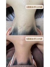 アンジェム(Angem)/5回お手入れでこの変化！！！