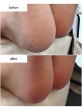 ケアプラス(care plus)/足裏角質ケア