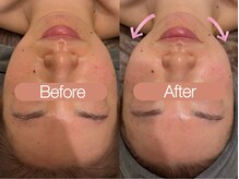 クレヴィア バイ サイバーエステ(CREBIA)/小顔コルギ＋ハイパーナイフEX