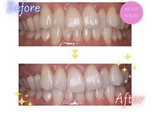 エクシアホワイトニング エミフルMASAKI店/ホワイトニングビフォーアフター