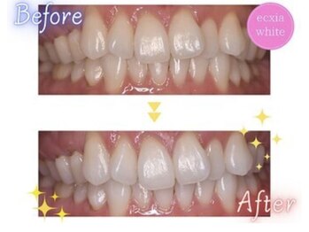 エクシアホワイトニング エミフルMASAKI店/ホワイトニングビフォーアフター