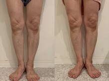 酵素TOKYO ナチュラ 渋谷 恵比寿店(natura)/左）ビフォー　右）アフター