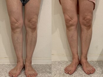 酵素TOKYO ナチュラ 渋谷 恵比寿店(natura)/左)ビフォー 右)アフター