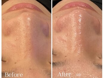 ユーフォリア グロウ(euphoria glow)/{ エイジングケアコース1回 }