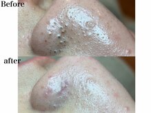 ウィタ(Wita)の雰囲気（皮脂分泌量は人それぞれ。継続することで毛穴レスを目指せます！）