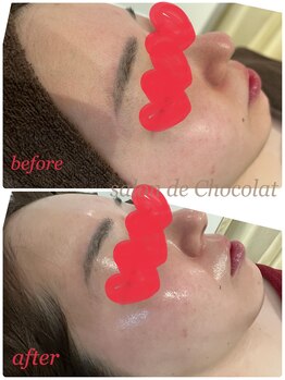 サロンドショコラ(salon de chocolat)/白玉酸素テラピー&ハイドラ