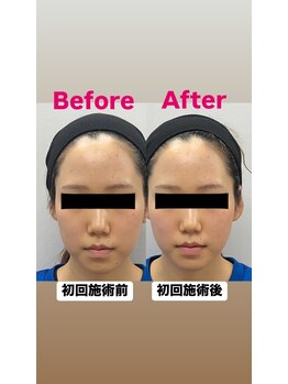 ゆうはり鍼灸整骨院 恵比寿/お客様Before　After