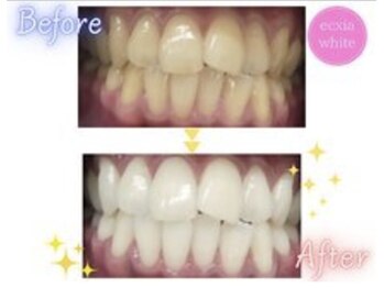 エクシアホワイトニング エミフルMASAKI店/ホワイトニングビフォーアフター